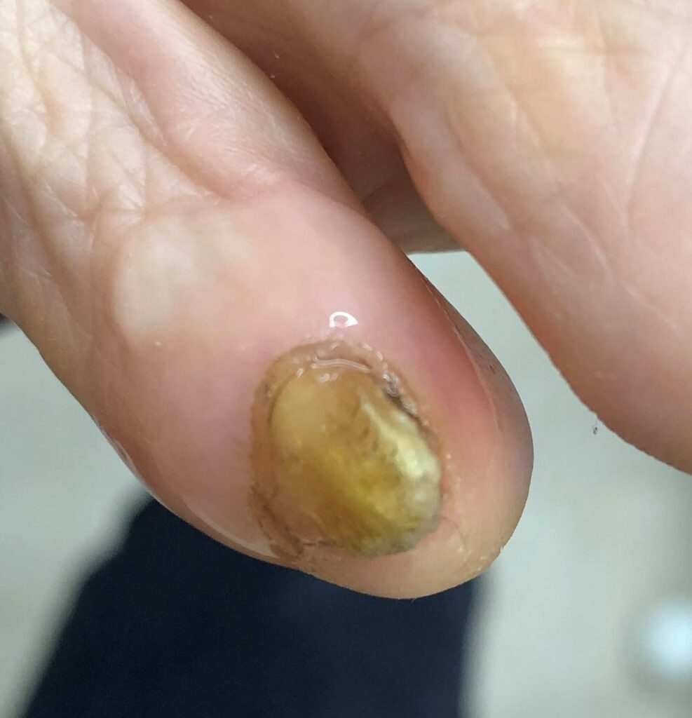 外反母趾,痛い,矯正,治す,整体,熊本,巻き爪,大きいサイズの靴,ダ・ヴィンチのあし,うおのめ,たこ,魚の目,皮膚科,レディース,大きいサイズ,25,25.5,こむらがえり,足がつる,フロムペディ,ベネシュ,シンシア,ラヴィー,ナラココ,巻き爪補正,名医,治療,ウオノメ,ル プレジール,かかと,名医