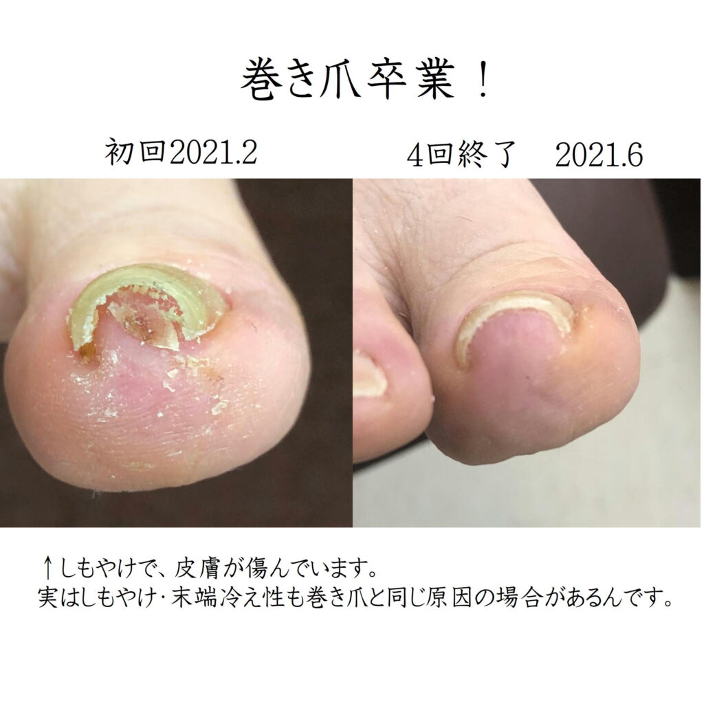 巻き爪60代女性２