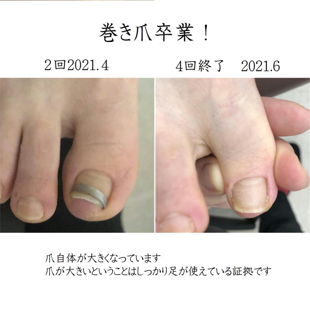 巻き爪60代女性１