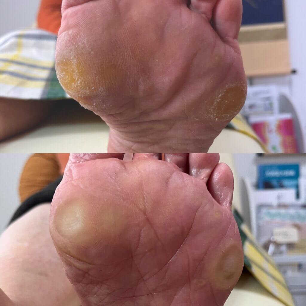 外反母趾,痛い,矯正,治す,整体,熊本,巻き爪,大きいサイズの靴,ダ・ヴィンチのあし,うおのめ,たこ,魚の目,皮膚科,レディース,大きいサイズ,25,25.5,こむらがえり,足がつる,フロムペディ,ベネシュ,シンシア,ラヴィー,ナラココ,巻き爪補正,名医,治療,ウオノメ,ル プレジール,