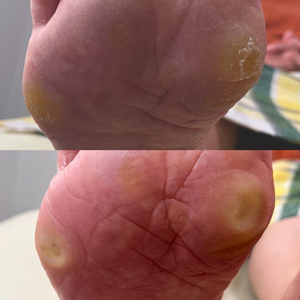 外反母趾,痛い,矯正,治す,整体,熊本,巻き爪,大きいサイズの靴,ダ・ヴィンチのあし,うおのめ,たこ,魚の目,皮膚科,レディース,大きいサイズ,25,25.5,こむらがえり,足がつる,フロムペディ,ベネシュ,シンシア,ラヴィー,ナラココ,巻き爪補正,名医,治療,ウオノメ,ル プレジール,