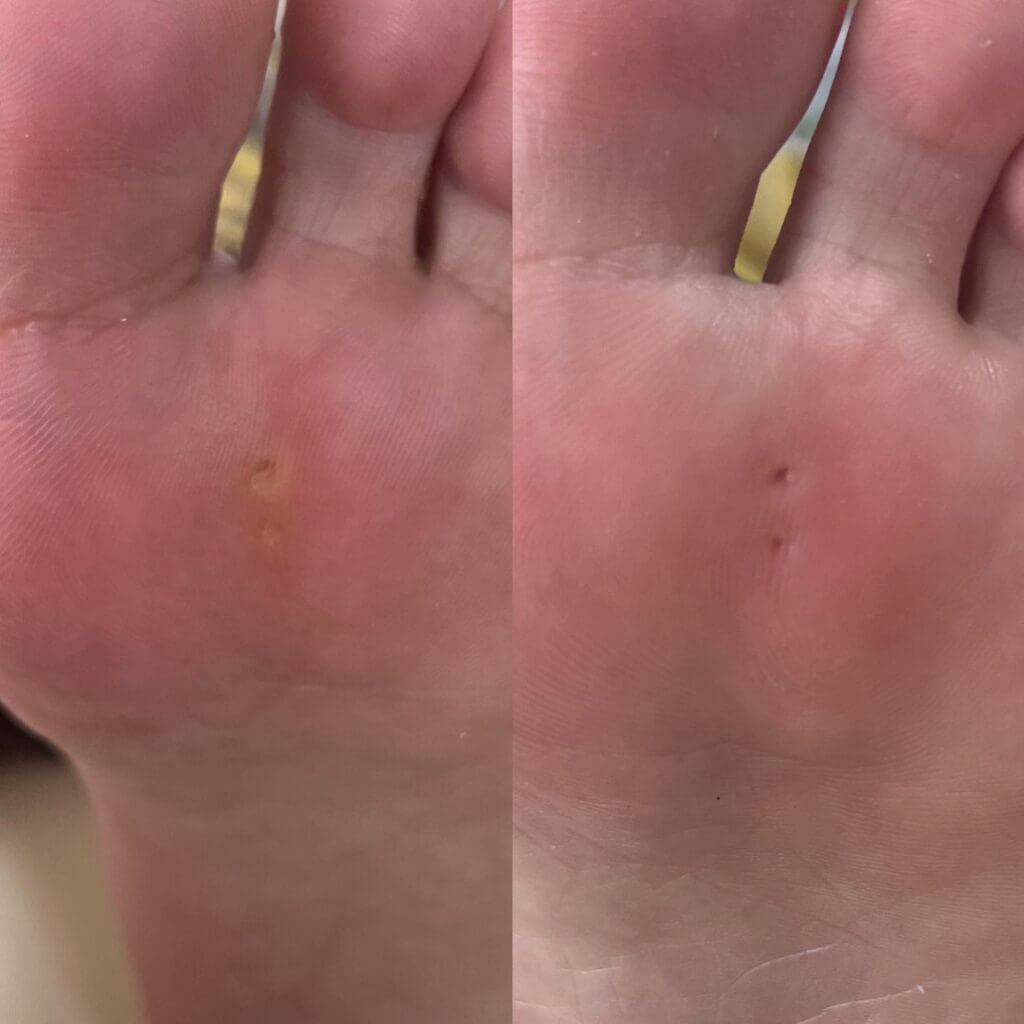 外反母趾,痛い,矯正,治す,整体,熊本,巻き爪,大きいサイズの靴,ダ・ヴィンチのあし,うおのめ,たこ,魚の目,皮膚科,レディース,大きいサイズ,25,25.5,こむらがえり,足がつる,フロムペディ,ベネシュ,シンシア,ラヴィー,ナラココ,巻き爪補正,名医,治療,ウオノメ,ル プレジール,