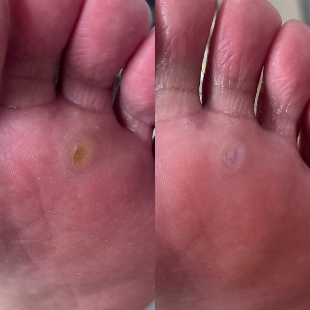 外反母趾,痛い,矯正,治す,整体,熊本,巻き爪,大きいサイズの靴,ダ・ヴィンチのあし,うおのめ,たこ,魚の目,皮膚科,レディース,大きいサイズ,25,25.5,こむらがえり,足がつる,フロムペディ,ベネシュ,シンシア,ラヴィー,ナラココ,巻き爪補正,名医,治療,ウオノメ,ル プレジール,