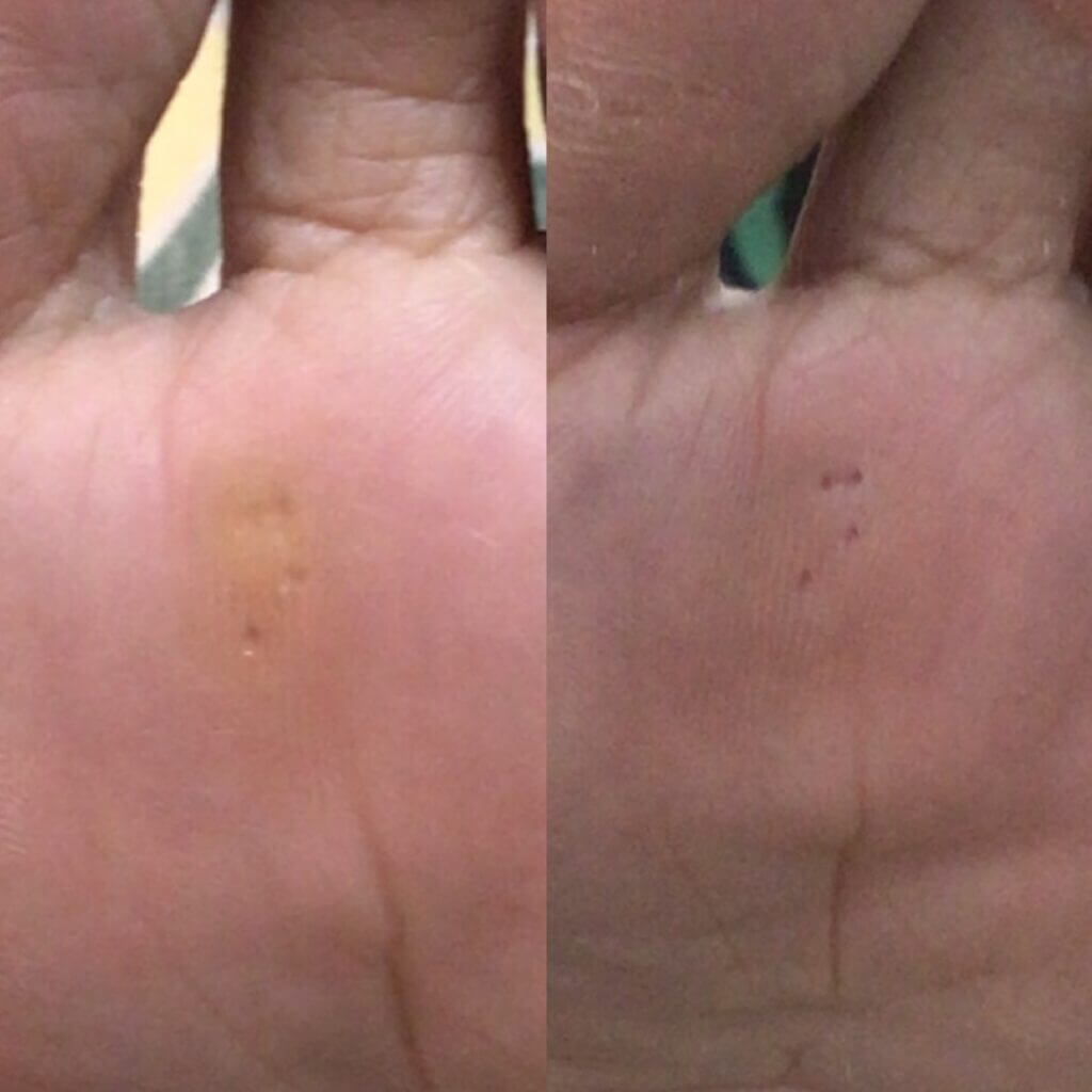 外反母趾,痛い,矯正,治す,整体,熊本,巻き爪,大きいサイズの靴,ダ・ヴィンチのあし,うおのめ,たこ,魚の目,皮膚科,レディース,大きいサイズ,25,25.5,こむらがえり,足がつる,フロムペディ,ベネシュ,シンシア,ラヴィー,ナラココ,巻き爪補正,名医,治療,ウオノメ,ル プレジール,