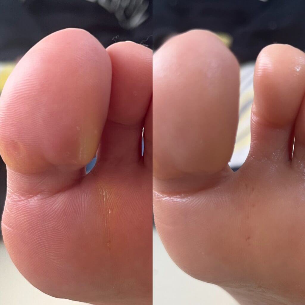 外反母趾,痛い,矯正,治す,整体,熊本,巻き爪,大きいサイズの靴,ダ・ヴィンチのあし,うおのめ,たこ,魚の目,皮膚科,レディース,大きいサイズ,25,25.5,こむらがえり,足がつる,フロムペディ,ベネシュ,シンシア,ラヴィー,ナラココ,巻き爪補正,名医,治療,ウオノメ,ル プレジール,