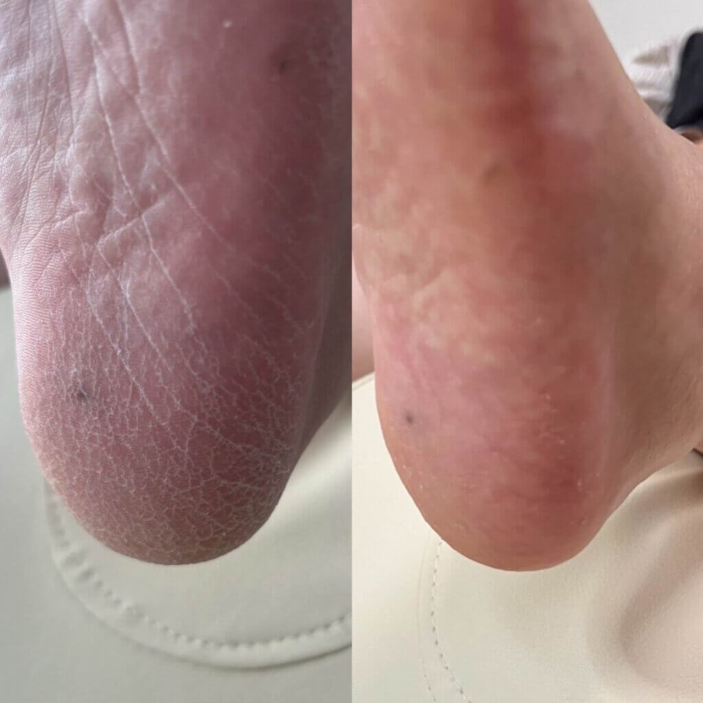 外反母趾,痛い,矯正,治す,整体,熊本,巻き爪,大きいサイズの靴,ダ・ヴィンチのあし,うおのめ,たこ,魚の目,皮膚科,レディース,大きいサイズ,25,25.5,こむらがえり,足がつる,フロムペディ,ベネシュ,シンシア,ラヴィー,ナラココ,巻き爪補正,名医,治療,ウオノメ,ル プレジール,かかと,手術,原因,治し方,フレイル,疲れやすい,カーブス,何科,バーニングフィート,用靴,親の介護