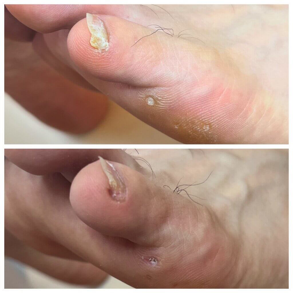 外反母趾,痛い,矯正,治す,整体,熊本,巻き爪,大きいサイズの靴,ダ・ヴィンチのあし,うおのめ,たこ,魚の目,皮膚科,レディース,大きいサイズ,25,25.5,こむらがえり,足がつる,フロムペディ,ベネシュ,シンシア,ラヴィー,ナラココ,巻き爪補正,名医,治療,ウオノメ,ル プレジール,かかと,手術,原因,治し方,フレイル,疲れやすい,カーブス,何科,バーニングフィート,用靴,親の介護