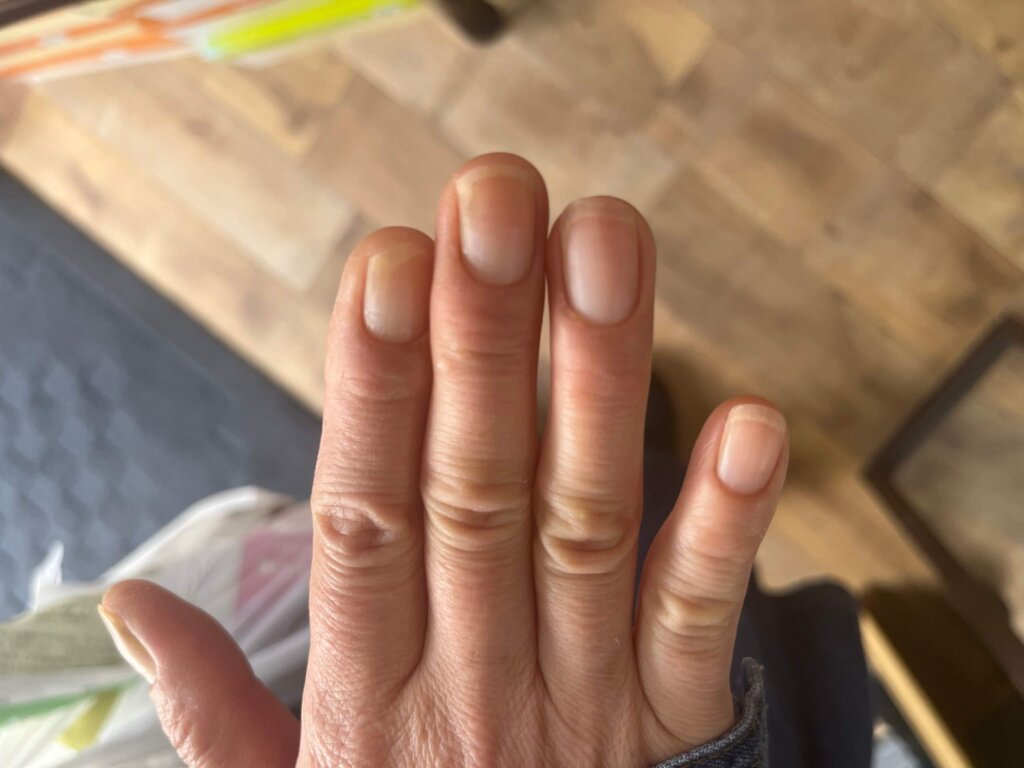 外反母趾,痛い,矯正,治す,整体,熊本,巻き爪,大きいサイズの靴,ダ・ヴィンチのあし,うおのめ,たこ,魚の目,皮膚科,レディース,大きいサイズ,25,25.5,こむらがえり,足がつる,フロムペディ,ベネシュ,シンシア,ラヴィー,ナラココ,巻き爪補正,名医,治療,ウオノメ,ル プレジール,かかと,手術,原因,治し方,フレイル,疲れやすい,カーブス,何科,バーニングフィート,用靴,親の介護,爪が伸びない